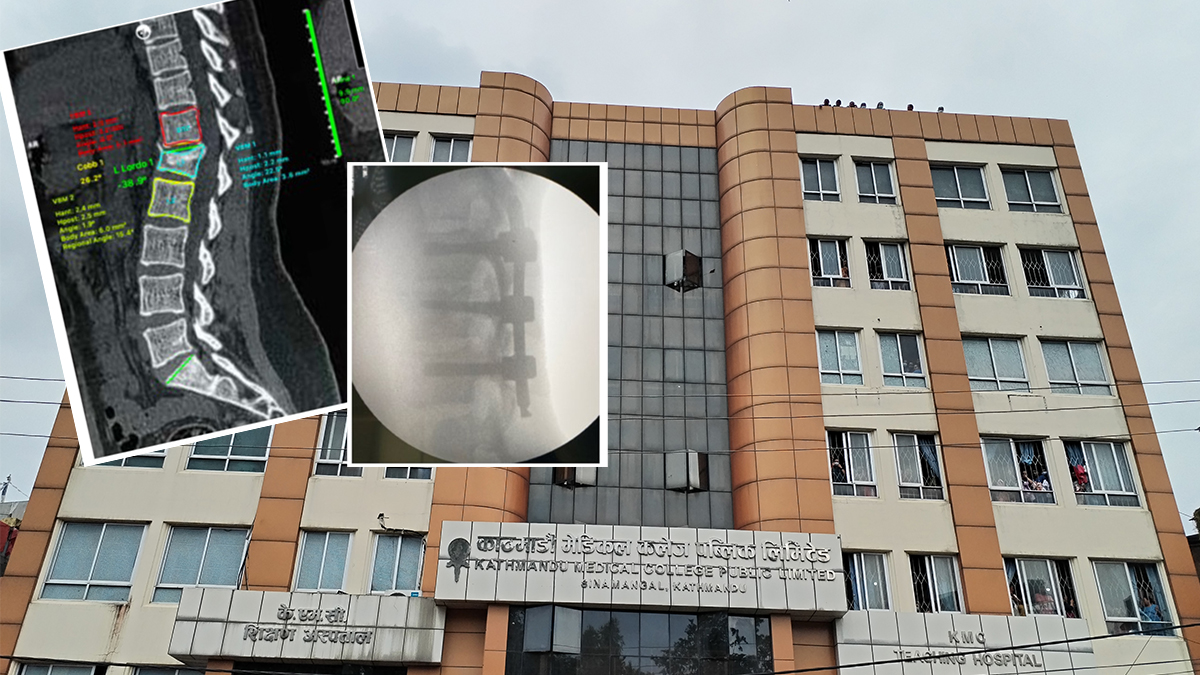 अप्रेसनको भोलीपल्ट नै बिरामी हिँडडुल गर्न सक्ने एमआईएस सर्जरी केएसमीमा
