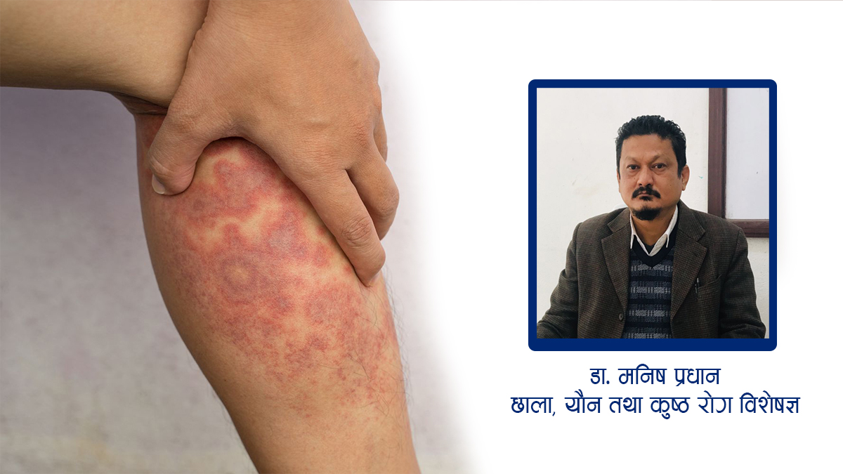 छालाका विभिन्न समस्याहरु र उपचारका लागि अल्ट्राभाइलेट लाइट थेरापी